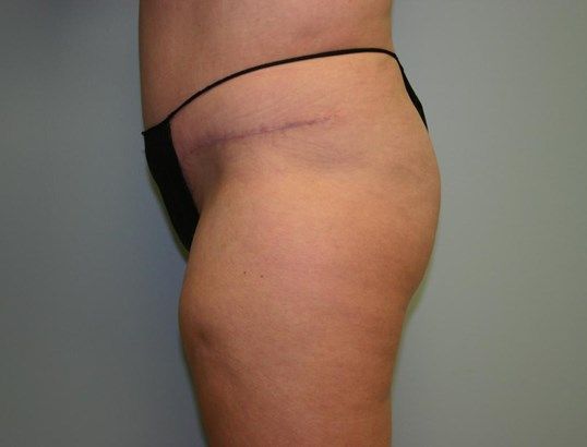 Tummy Tuck Before & After