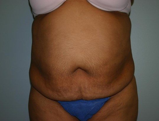 Tummy Tuck Before & After