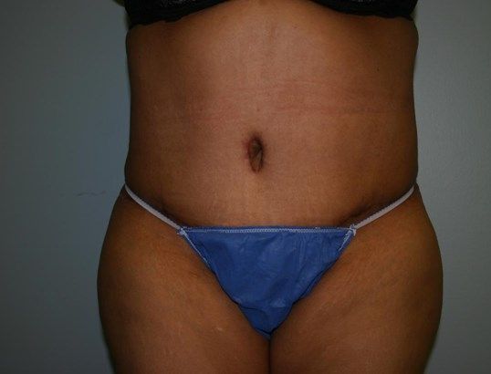 Tummy Tuck Before & After