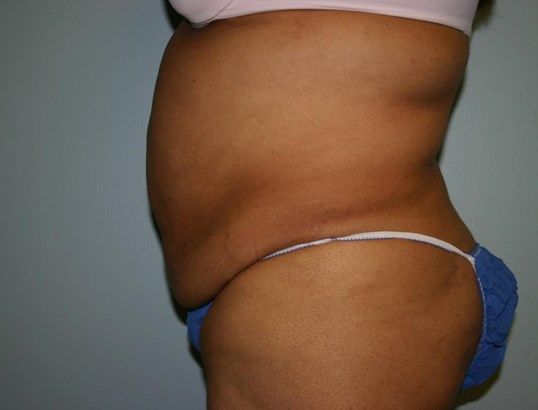 Tummy Tuck Before & After