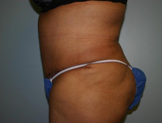 Tummy Tuck Before & After