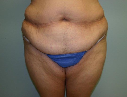 Tummy Tuck Before & After