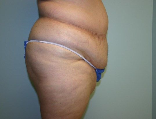 Tummy Tuck Before & After