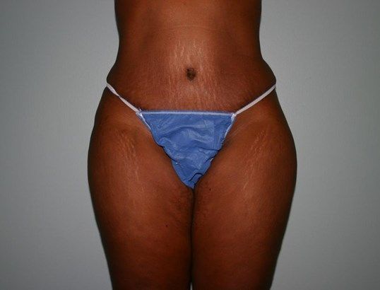 Tummy Tuck Before & After