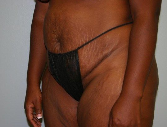 Tummy Tuck Before & After