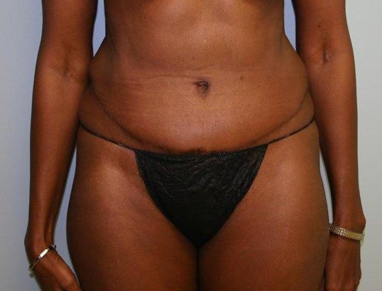 Tummy Tuck Before & After