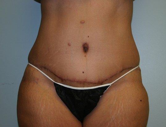 Tummy Tuck Before & After