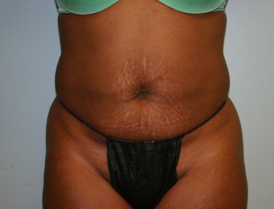 Tummy Tuck Before & After