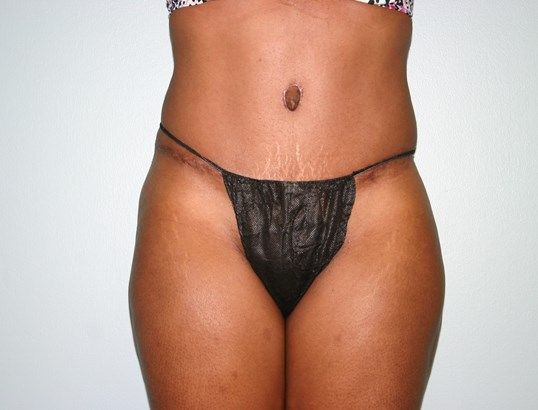 Tummy Tuck Before & After