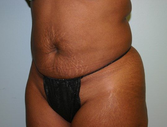 Tummy Tuck Before & After