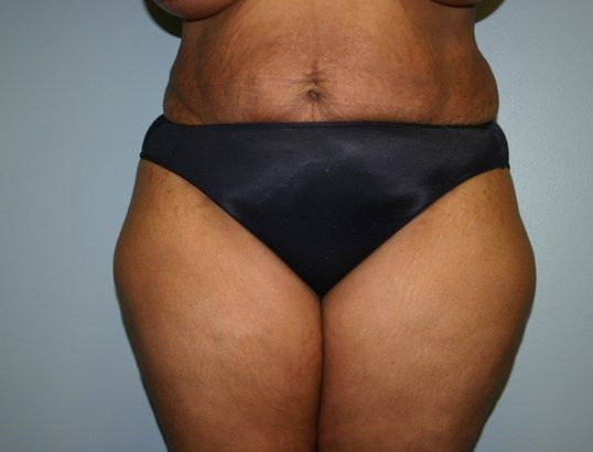 Tummy Tuck Before & After