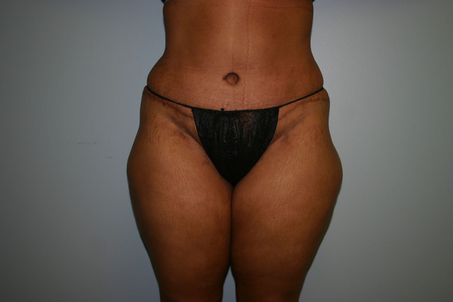 Tummy Tuck Before & After