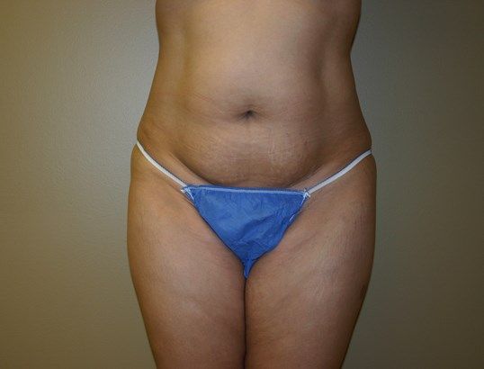 Tummy Tuck Before & After
