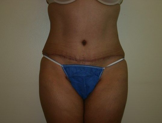 Tummy Tuck Before & After