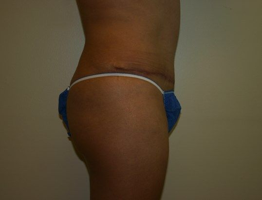 Tummy Tuck Before & After