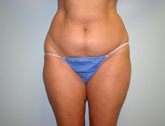 Tummy Tuck Before & After