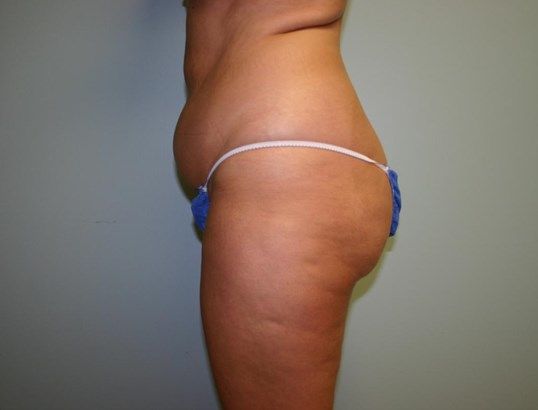 Tummy Tuck Before & After