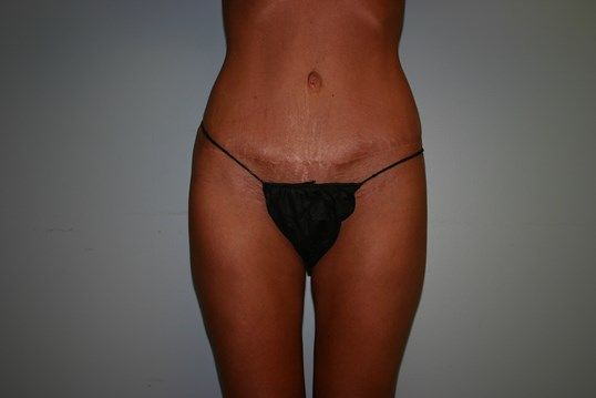 Tummy Tuck Before & After