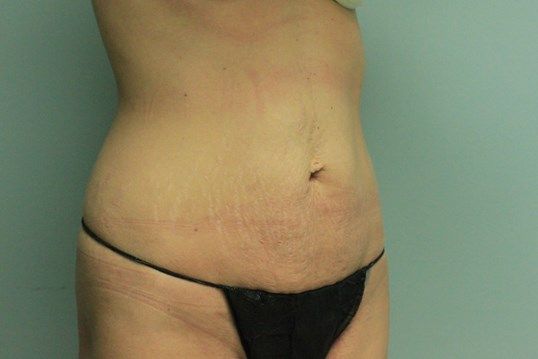 Tummy Tuck Before & After