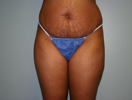 Tummy Tuck Before & After