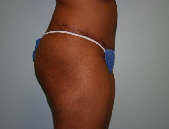 Tummy Tuck Before & After