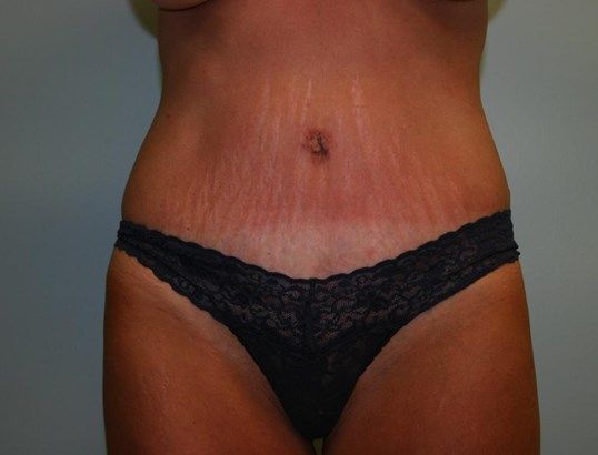 Tummy Tuck Before & After