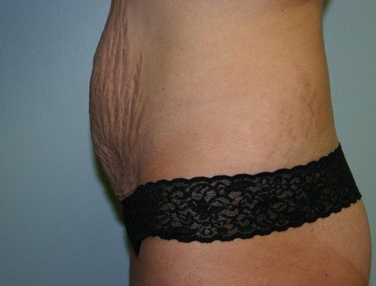 Tummy Tuck Before & After