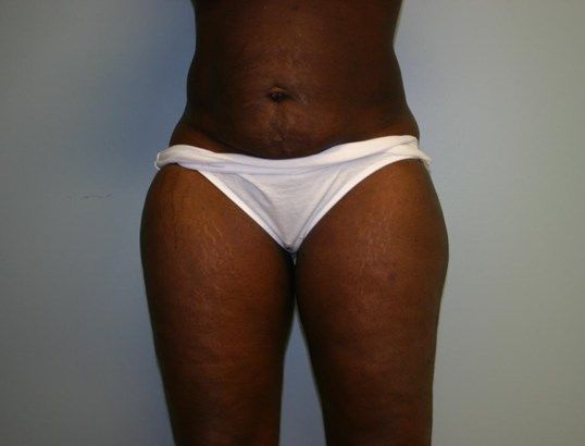 Tummy Tuck Before & After