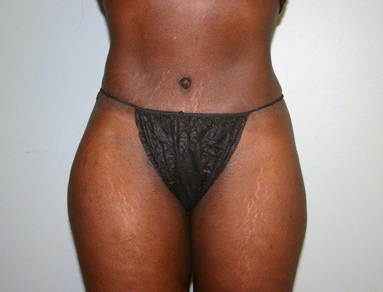 Tummy Tuck Before & After