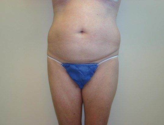Tummy Tuck Before & After