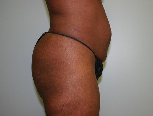 Tummy Tuck Before & After