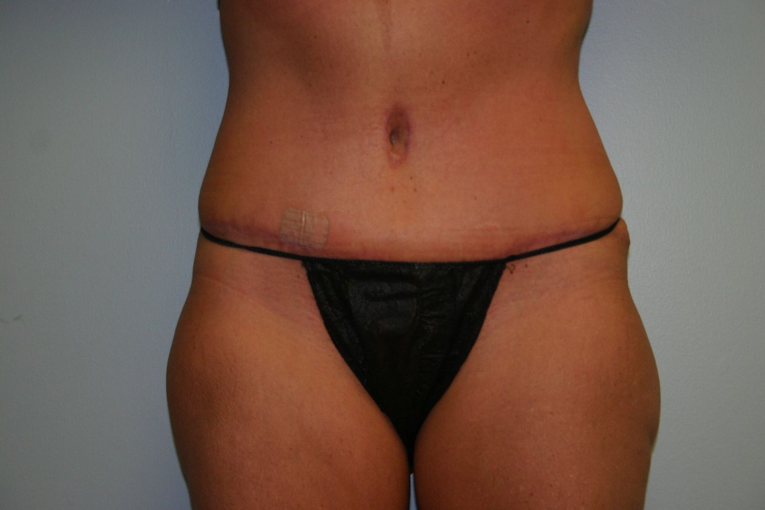 Tummy Tuck Before & After