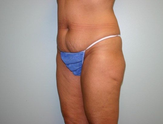 Tummy Tuck Before & After