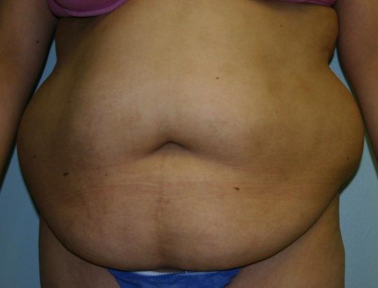 Tummy Tuck Before & After