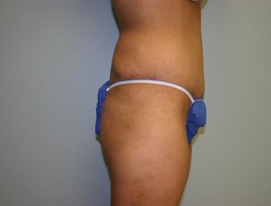 Tummy Tuck Before & After