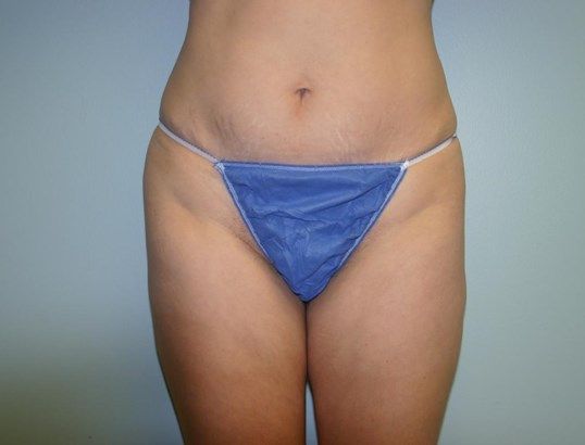 Tummy Tuck Before & After