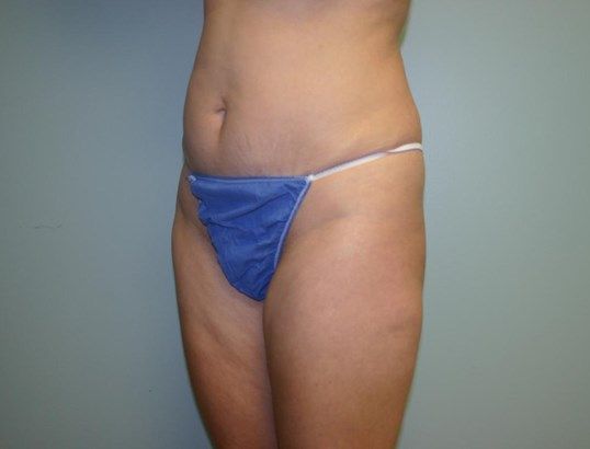 Tummy Tuck Before & After