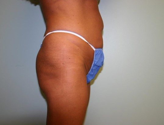 Tummy Tuck Before & After