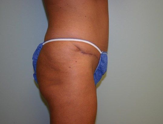 Tummy Tuck Before & After