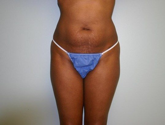 Tummy Tuck Before & After