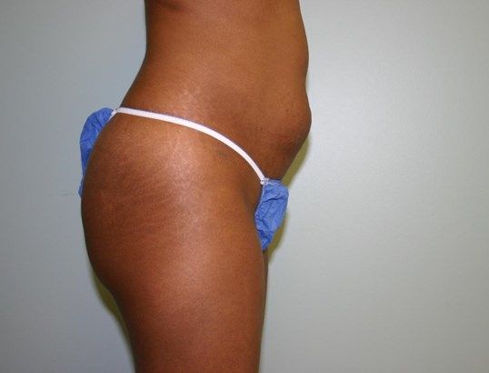 Tummy Tuck Before & After