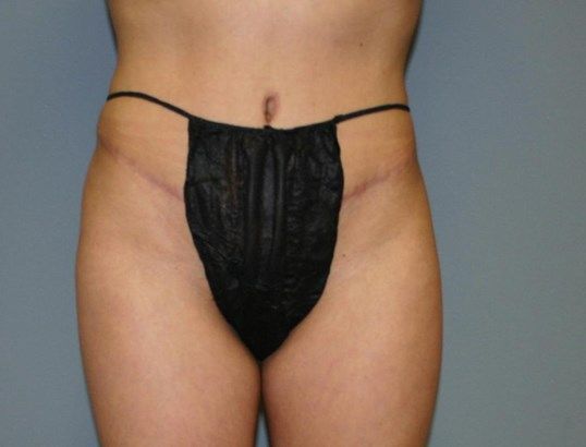 Tummy Tuck Before & After