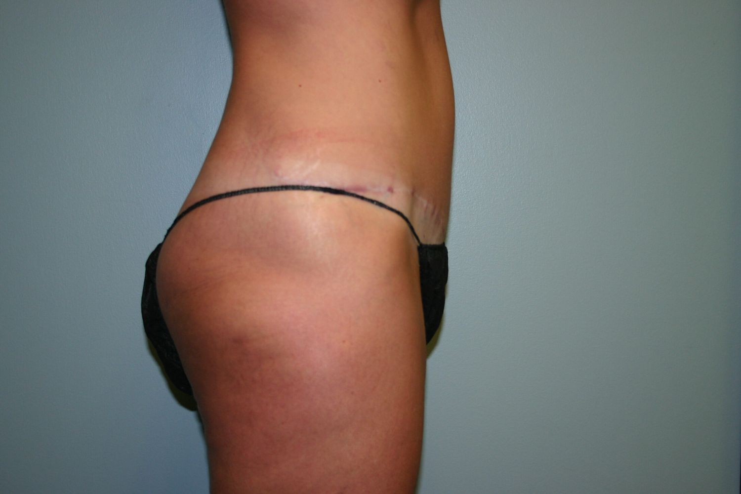 Tummy Tuck Before & After