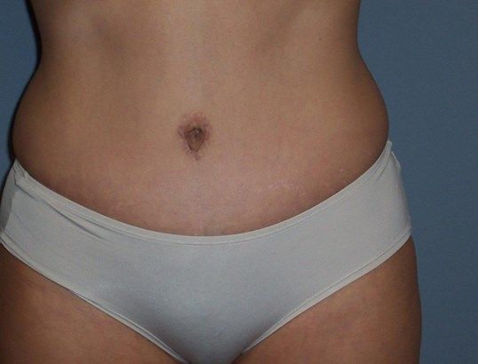 Tummy Tuck Before & After
