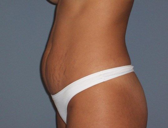 Tummy Tuck Before & After