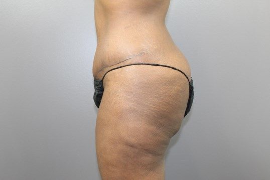 Tummy Tuck Before & After