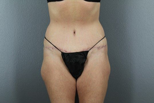 Tummy Tuck Before & After