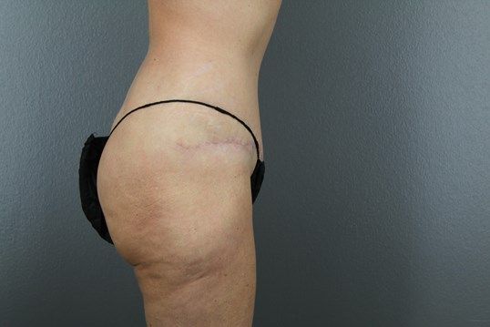 Tummy Tuck Before & After