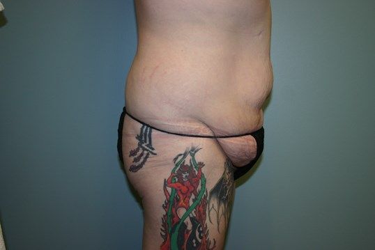 Tummy Tuck Before & After