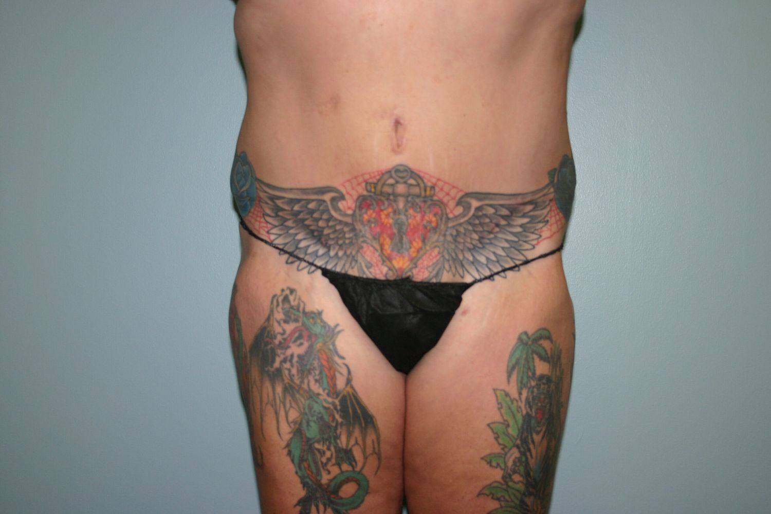 Tummy Tuck Before & After